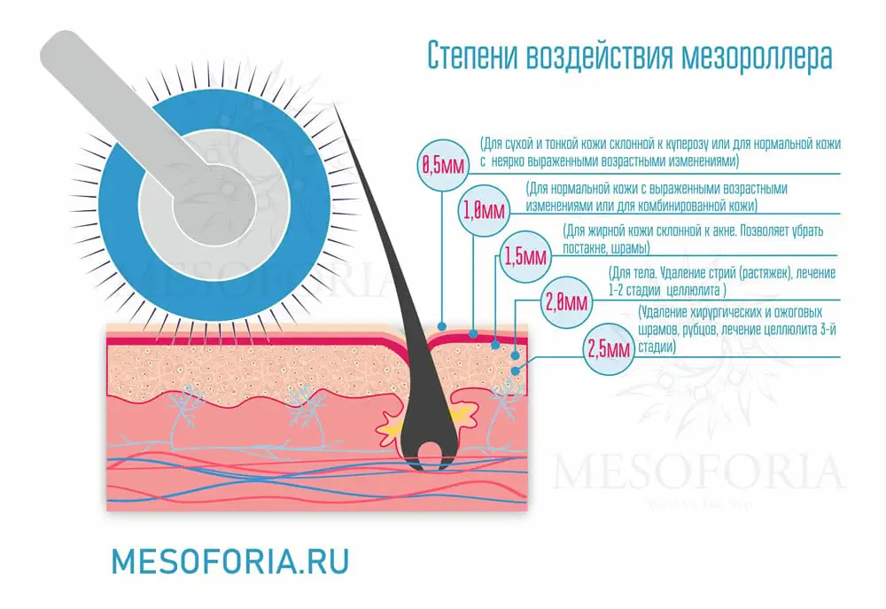 Степени воздействия мезороллера