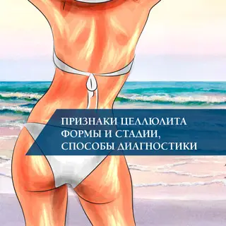 Признаки целлюлита формы и стадии, способы диагностики