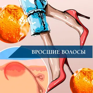 Вросшие волосы