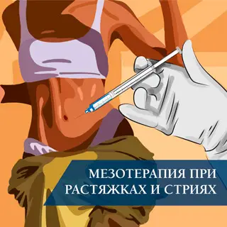 Мезотерапия при растяжках (стриях)