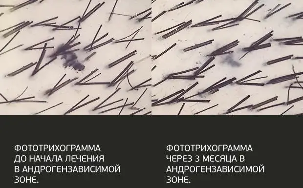 фототрихограмма