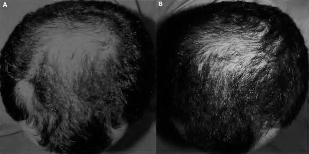 Волосы до и после применения REVOLOS