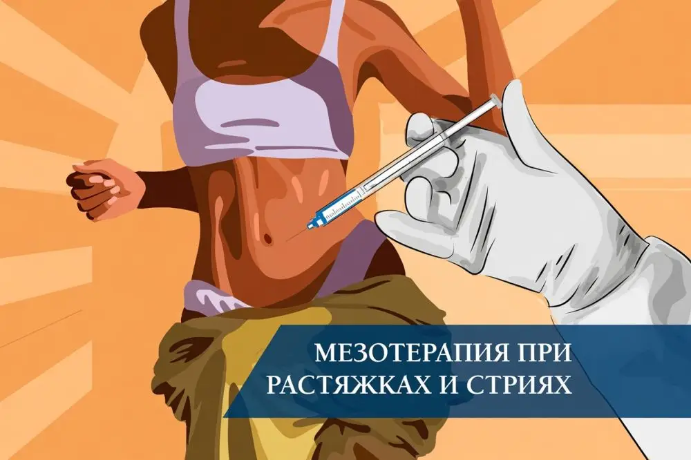 Мезотерапия при растяжках (стриях)