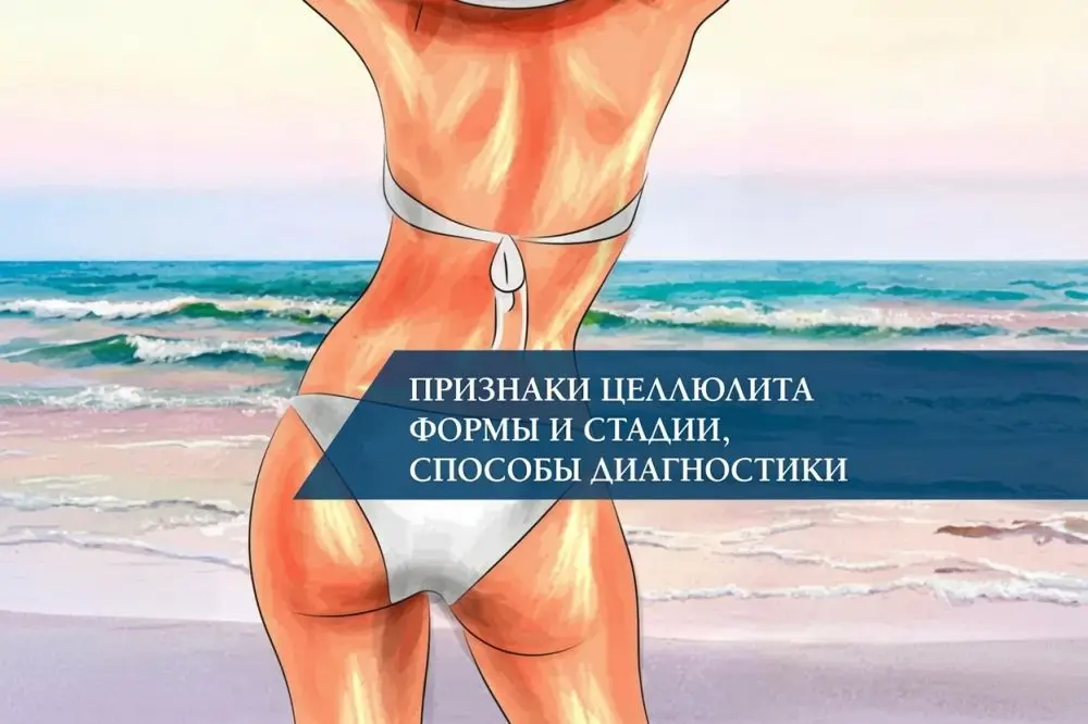 Признаки целлюлита формы и стадии, способы диагностики