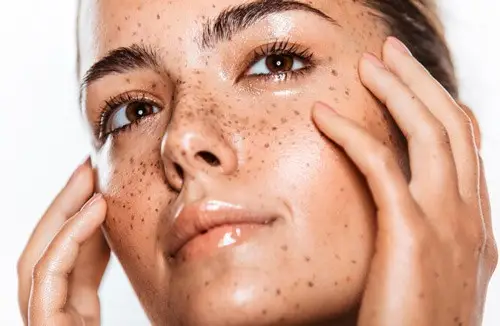 Пигментные пятна на лице Пигментные пятна на лице