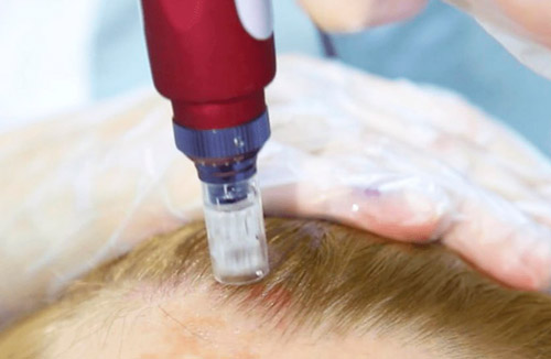 Аппараты фракционной мезотерапии для активизации роста волос